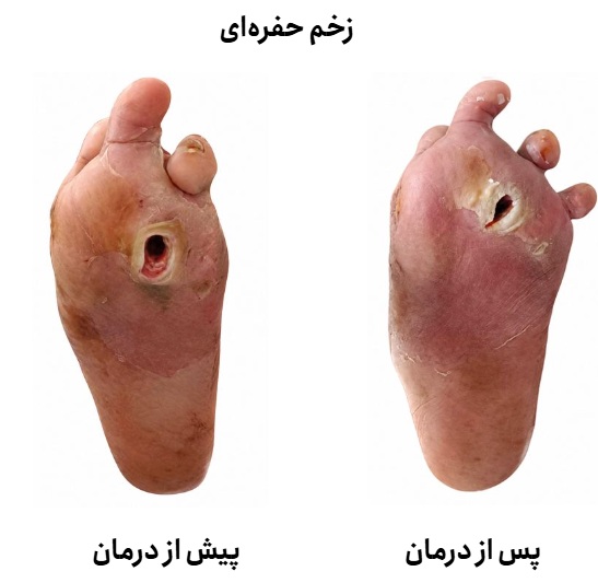 حفره ای