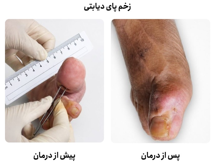 دیابت