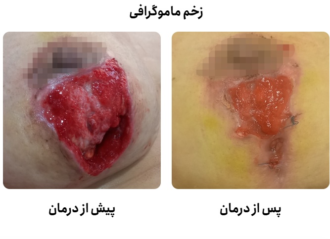 ماموگرافی